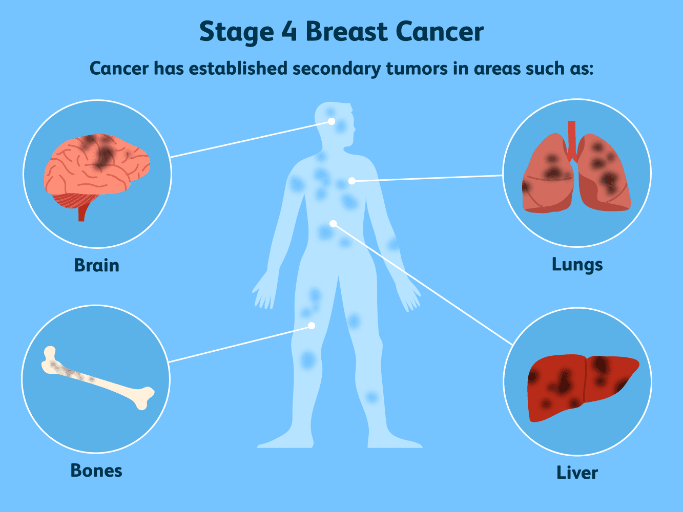 Best Breast Cancer Treatment Doctor in Hyderabad